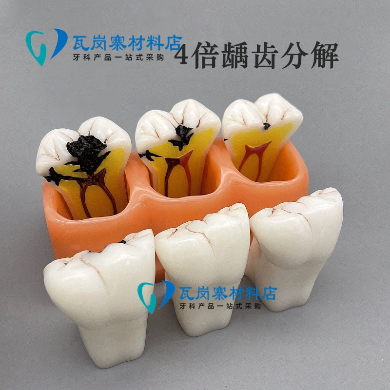 牙科口腔模型6倍龋齿对比 4倍分类 2倍牙齿演变蛀牙分解病理医患