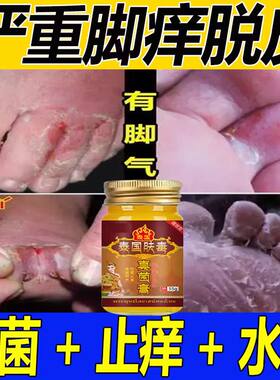 泰国脚气王烂脚丫脚痒水泡脚