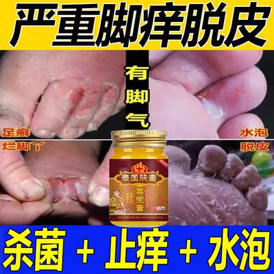 泰国脚气王烂脚丫脚痒水泡脚
