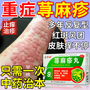 荨麻疹过敏止痒断药根专用药【进口服用 视觉特效】荨麻疹丸