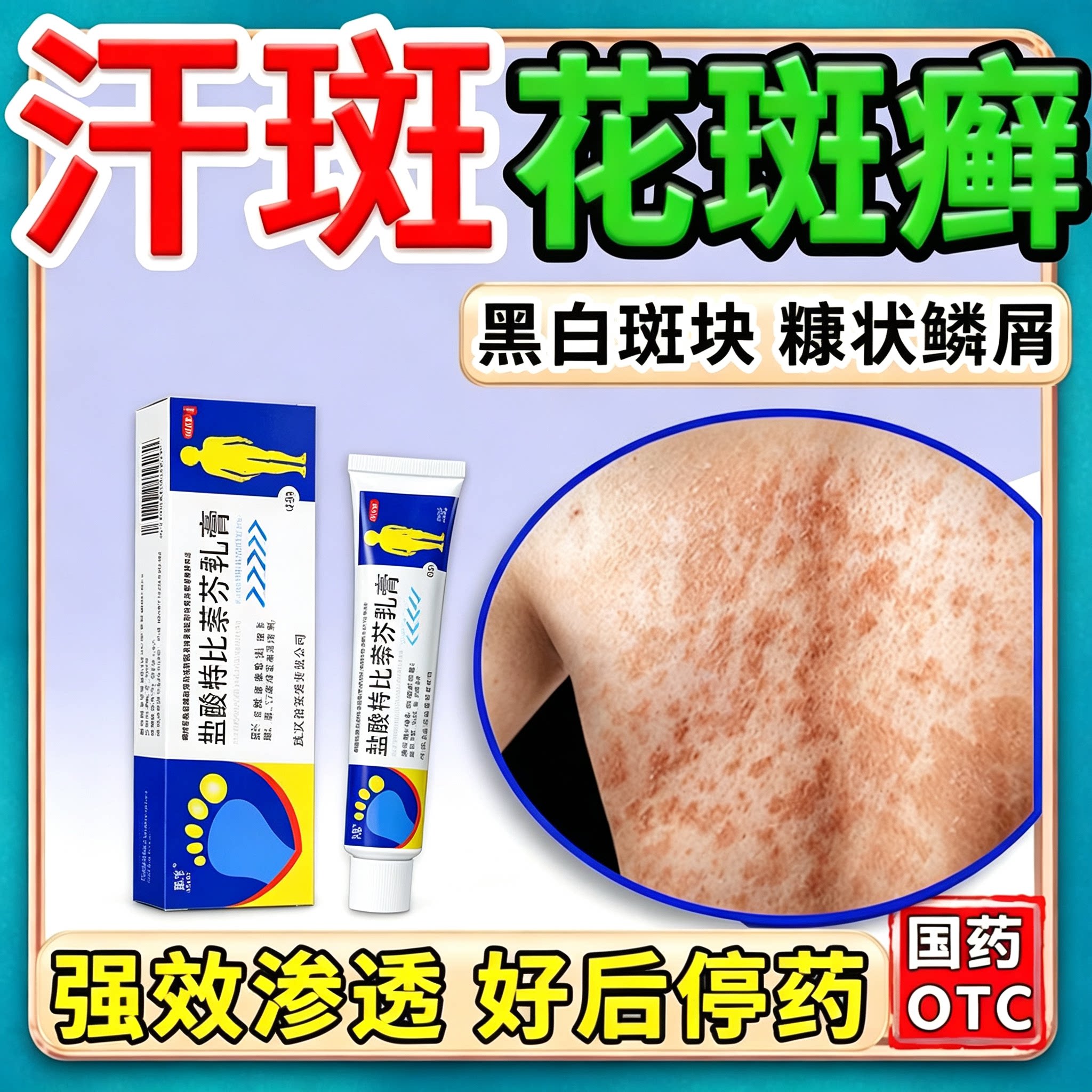 汗斑花斑癣专用特新效期药膏医用级盐酸特比萘芬乳膏正品旗舰店