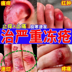 冻疮药膏排行榜第一名冻伤膏耳朵脸部手指冻伤药皲裂消酊鼎芙膏
