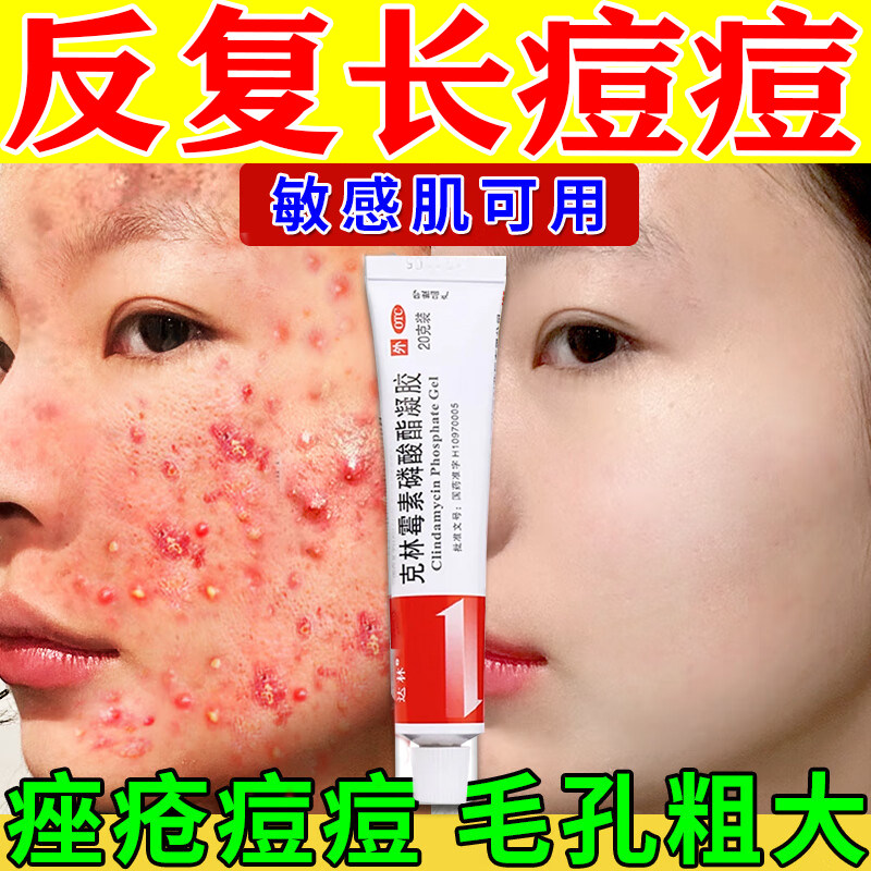 克林霉素磷酸酯凝胶祛痘祛痘印修复淡化去痘印引起的黑色素沉淀
