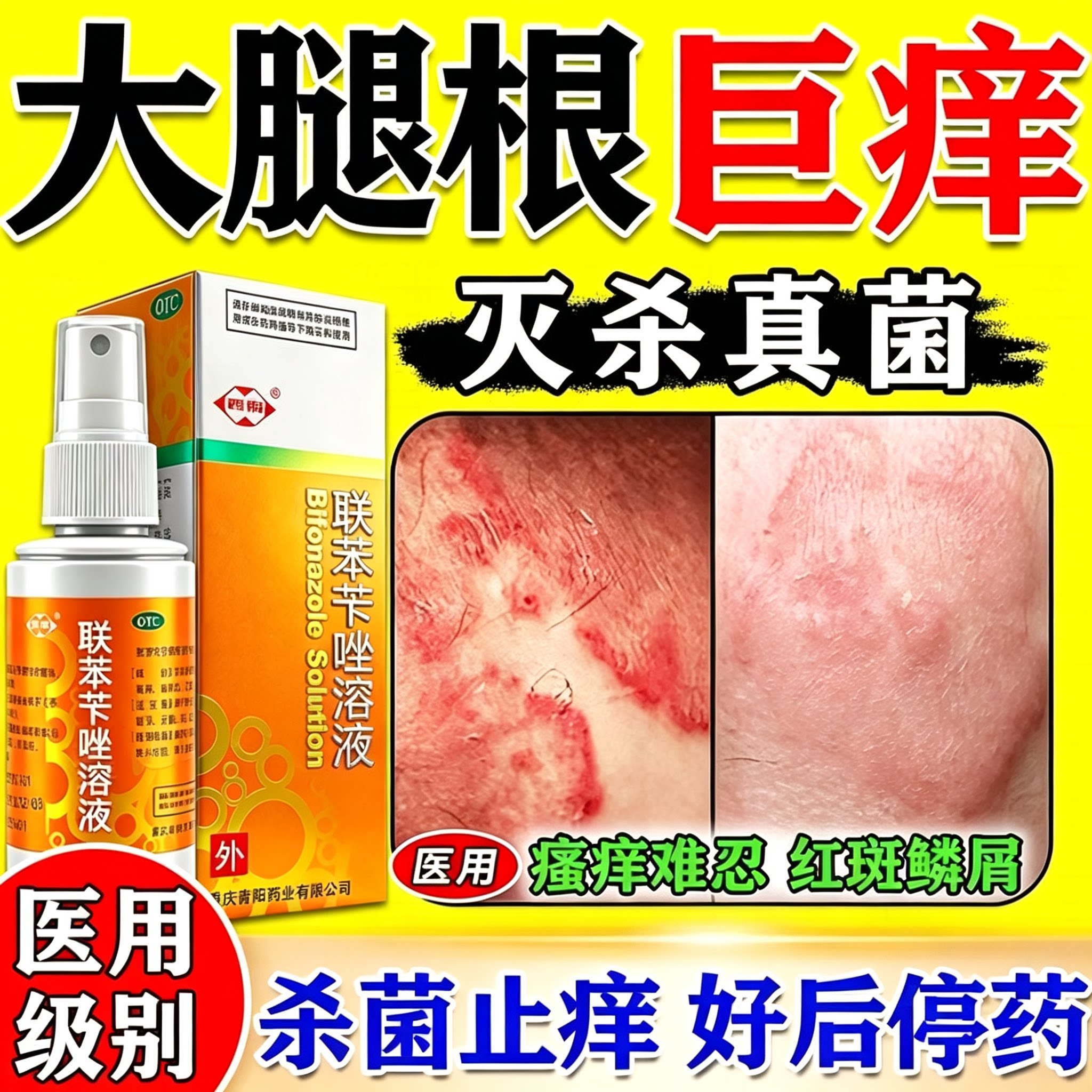 大腿内侧真菌感染股藓专用药阴囊潮湿疹瘙痒私处止痒联苯苄唑溶液