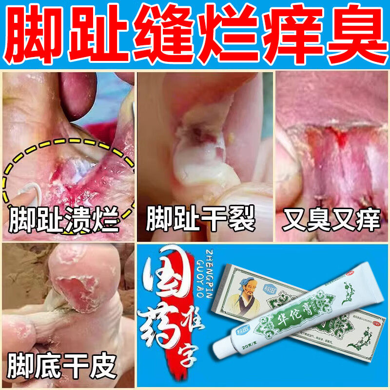 脚气根去专用特效脚趾缝烂痒脱皮治疗脚气止痒脱皮杀菌膏药华佗膏