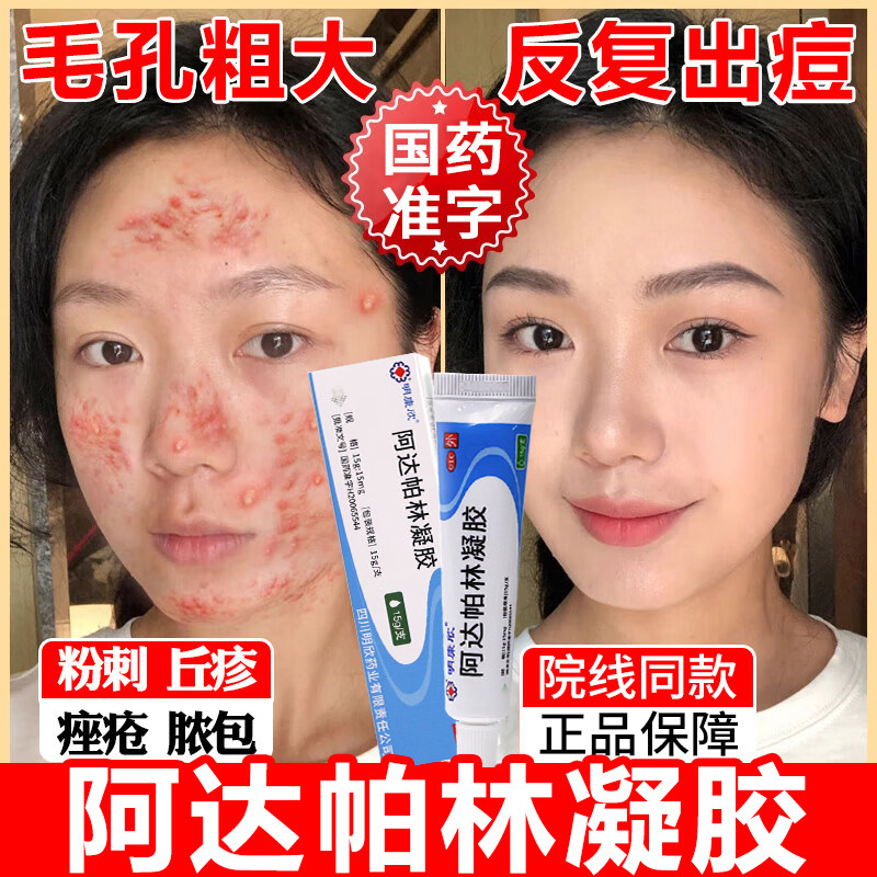 【鑫烨】阿达帕林凝胶0.1%*10g*1支/盒