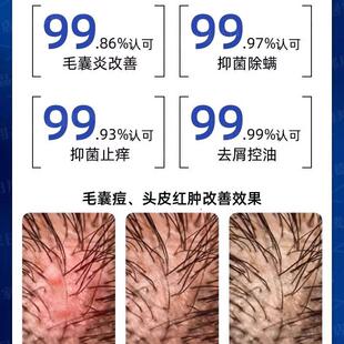 头皮毛囊炎头屑脂溢性皮炎真菌感染顽固头癣疙瘩杀菌止痒苦参喷剂