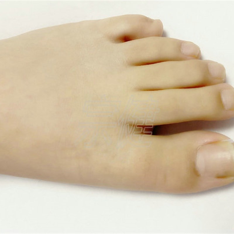 宗健槽状填充垫 嵌甲矫正器 贴片甲沟 脚趾甲丝工具长肉 正甲片炎