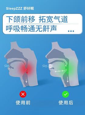 止鼾牙套神LJB器阻腔止打鼾呼噜止鼾器呼吸暂停口打治器机防矫呼