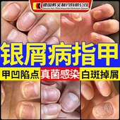 银屑病甲真菌感染膏药贴空甲专用手脚指甲发黄增厚修复液体敷料CS