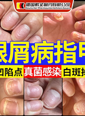 银屑病甲真菌感染膏药贴空甲专用手脚指甲发黄增厚修复液体敷料CS