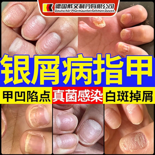 银屑病甲真菌感染膏药贴空甲专用手脚指甲发黄增厚修复液体敷料CS