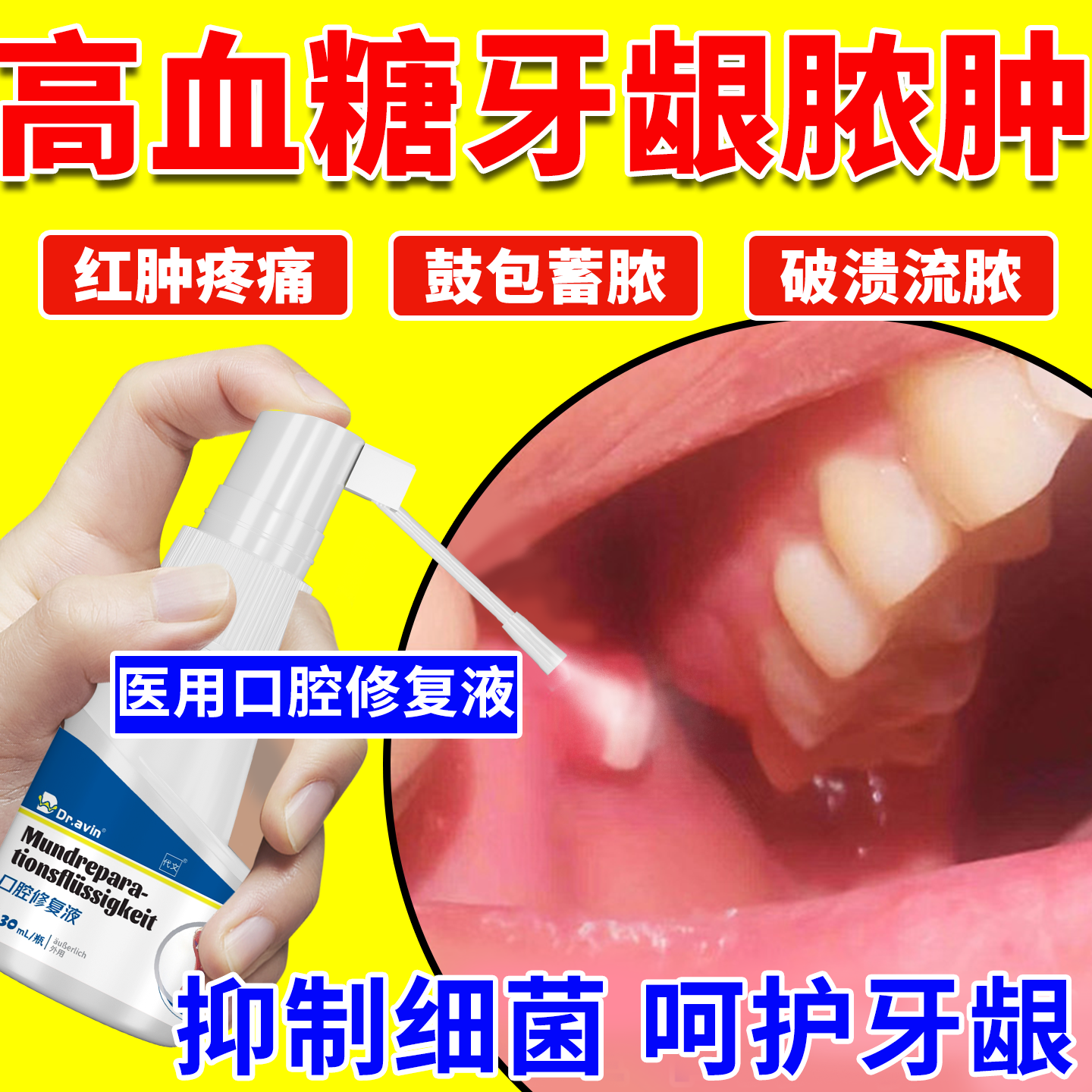 高血糖牙龈牙齿脓包囊肿痛消炎专用膏药贴治牙根发炎口腔修复液CS