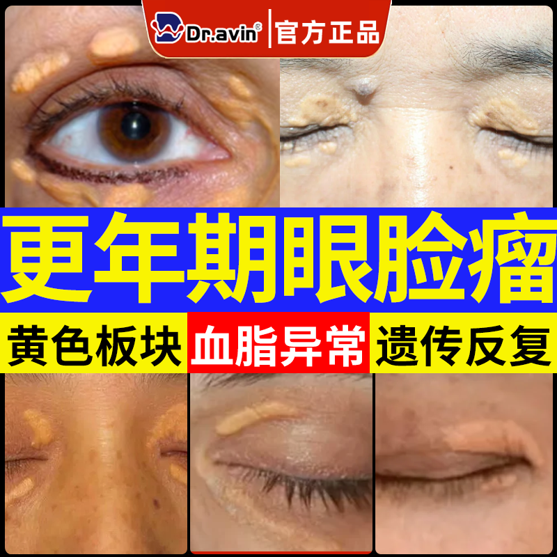 眼部眼角眼眉眼睑黄瘤留去眼皮黄斑瘤专用黄疣膏药贴去除神器CS