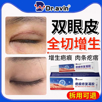 全切双眼皮【增生疤痕】