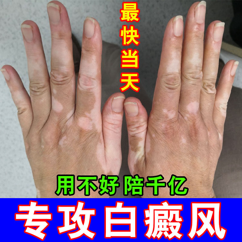 白颠风外用黑色素促进生长白斑静花斑快速消白斑补骨外用当天消白