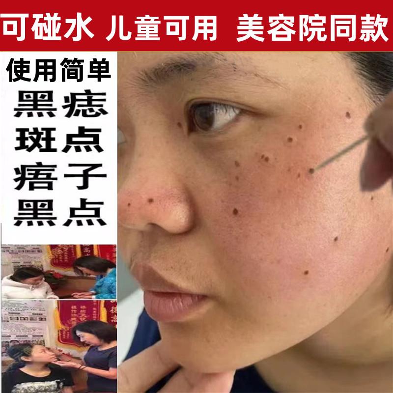 点斑水痣膏正品脸部药取痣去黑痣雀点痦子美容院专用神器去除志仪