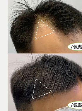 男士假浏海片鬓角补发假发片男女全真人发m型前额发际线假发贴片