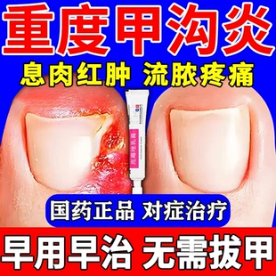 甲沟炎治疗专用药息肉去除指甲长肉里脚趾真菌感染嵌甲化脓消肿药