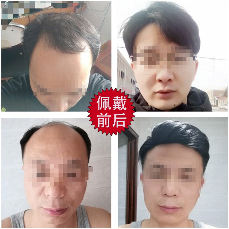 男士假发短发帅气韩版头顶补发片偏分秃顶前额中老年男式真发补发