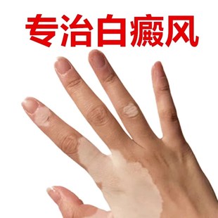 【康复疗程】补骨脂白斑抑菌液白风外用酊膏促黑色素汗斑净专用手