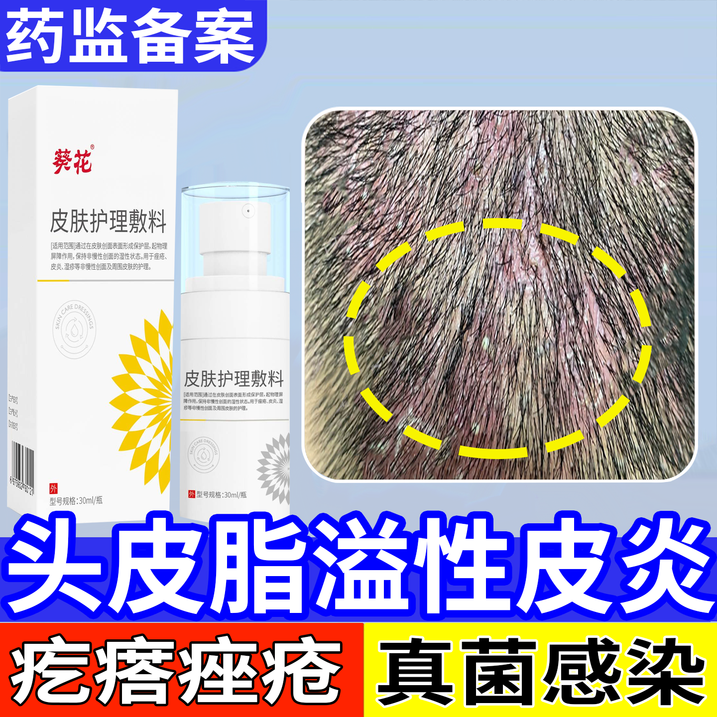 头皮屑脂溢性皮炎真菌感染头癣部喷剂精华头痒有疙瘩痤疮马拉色菌