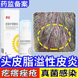 头皮屑脂溢性皮炎真菌感染头癣部喷剂精华头痒有疙瘩痤疮马拉色菌