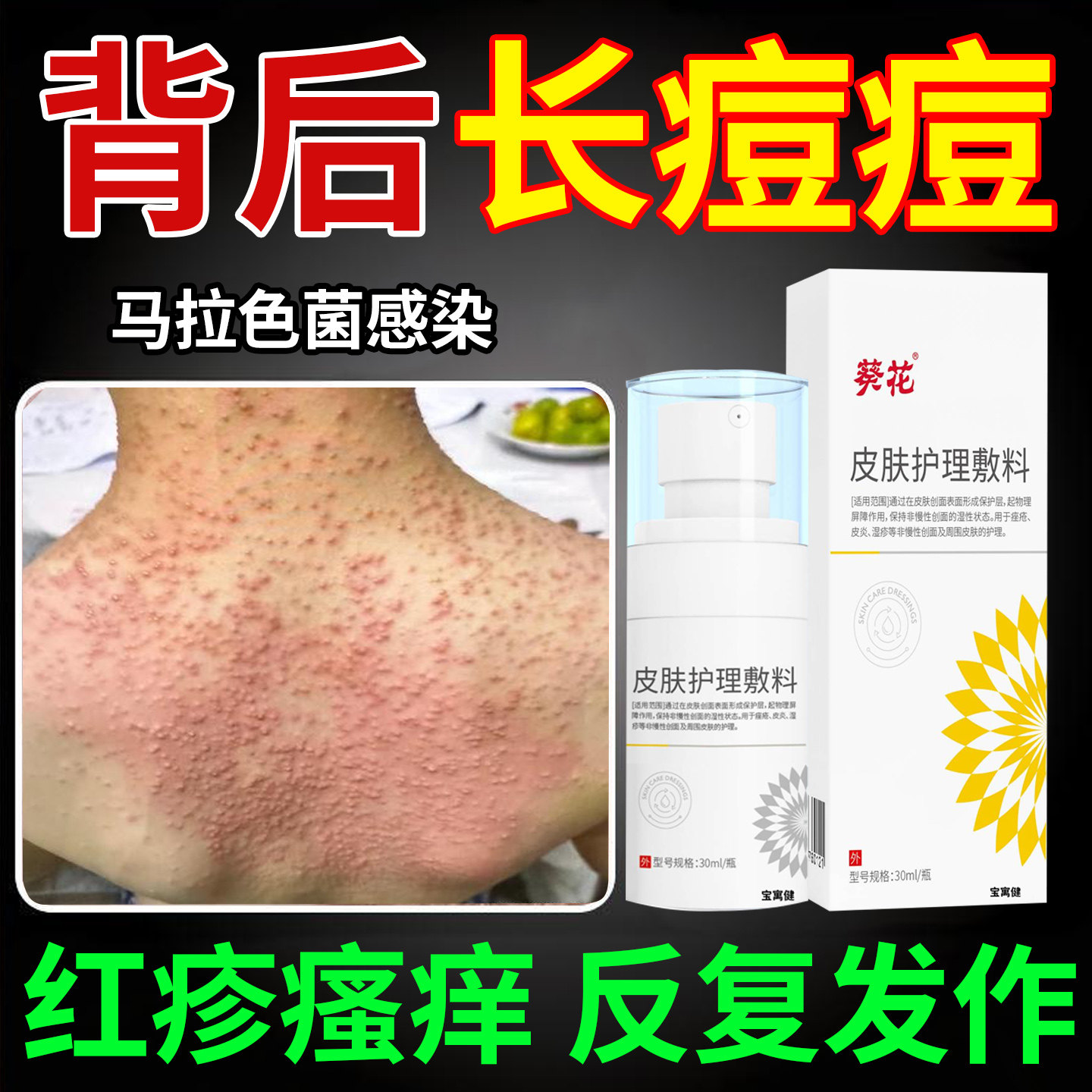 前胸背后长痘痘后背毛囊炎除螨祛痘痒喷雾剂马拉色菌感染专用药膏