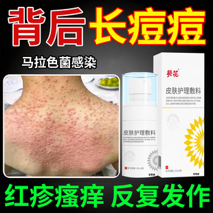 前胸背后长痘痘后背毛囊炎除螨祛痘痒喷雾剂马拉色菌感染专用药膏