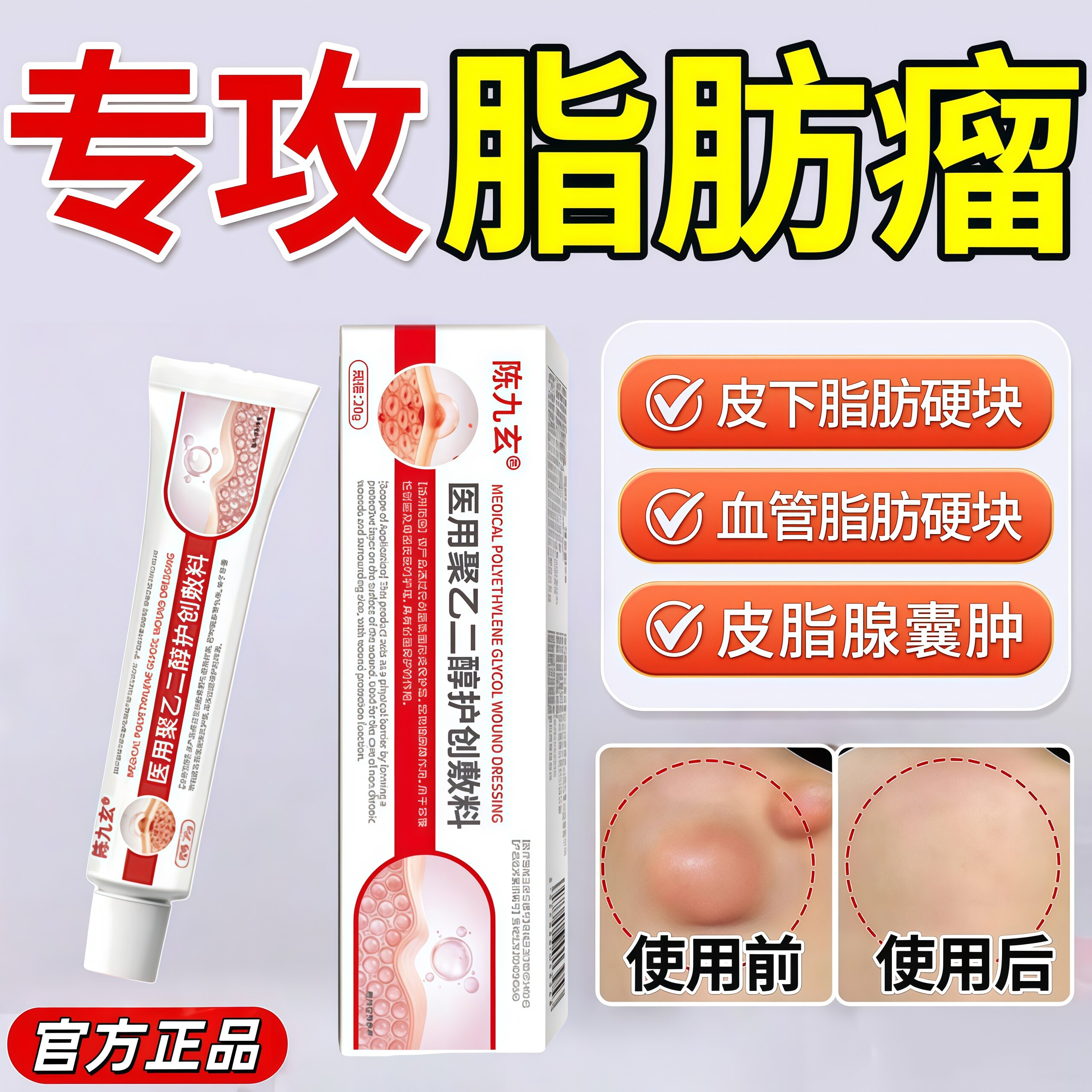 陈九玄脂肪瘤消瘤膏皮下硬块