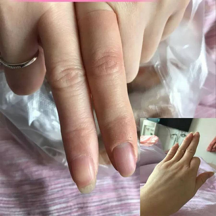 丹蓉硅胶手指假肢残疾仿真义肢脚趾量身半指全掌半掌