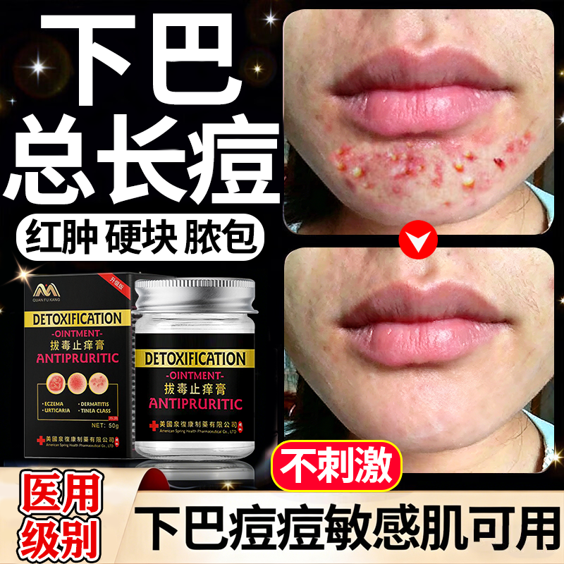 下巴反复长痘淋巴痘腮边痘玫瑰痤疮屏障修复脓包型重度暗疮脸上痘