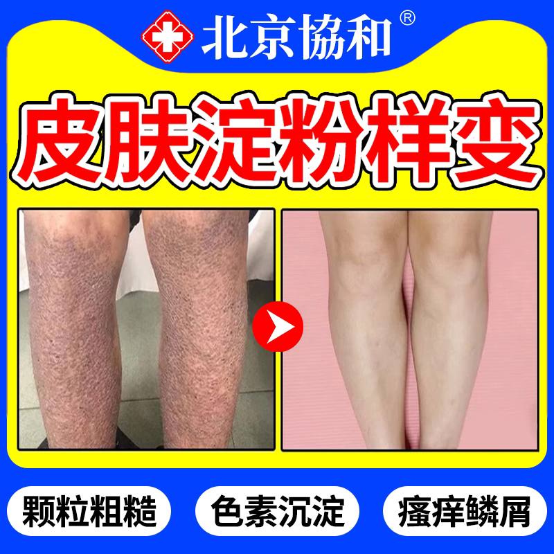 皮肤淀粉样变非专用胳膊小腿治顽固性皮癣后背黑色素沉淀粗糙颗粒
