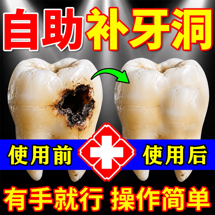 【补牙材料】光固化补牙洞材料