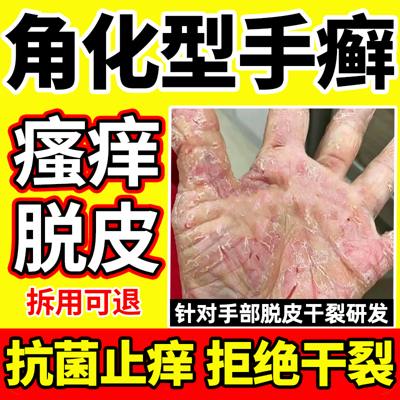 手指角化型湿疹鹅掌风非专用手癣膏手部脱皮干裂真菌感染止痒抗菌