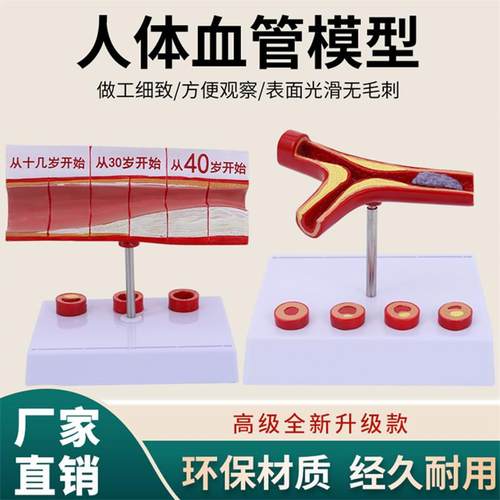 冠状动脉性心血管动脉模型硬化模型 老年心脏模型血栓模型