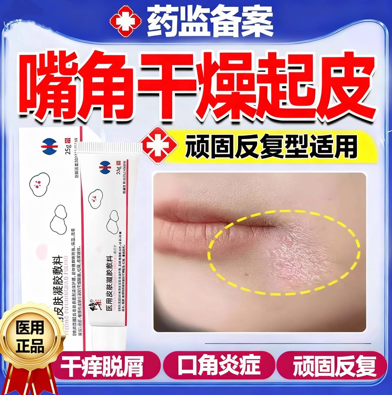 嘴角干燥干起皮口周皮炎药监备案膏口角炎烂嘴角癣脸唇上有碎屑裂