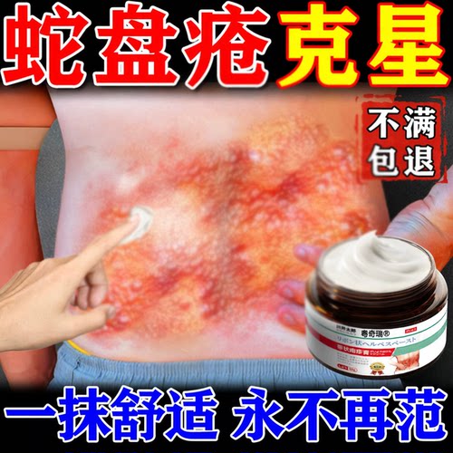 【带状疹克星】蛇缠腰带状外用膏