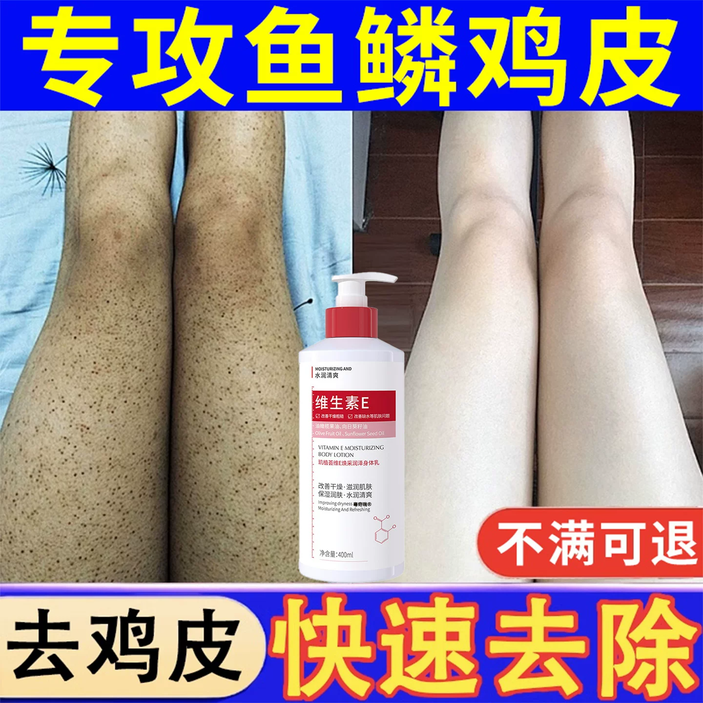 【专攻鸡皮干裂肤】医用级维E乳