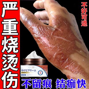 湿润烧烫伤膏蒸汽烫伤热油开水烫不留疤痕外用皮肤烫伤膏烧伤正品
