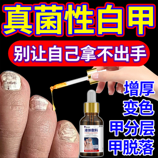 真菌性白甲空甲修复液感染手脚灰指甲发白变厚甲床分离白斑专用YF