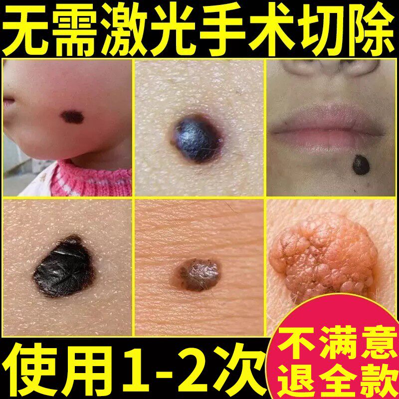 点痣膏无痕官方正品旗舰店黑痣痦子专用脸部痣非取祛去神器修复液