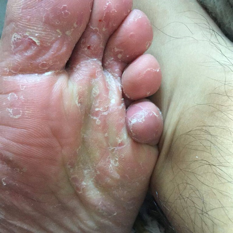 脚底板严重脱皮常k年脱皮脚底干燥止起皮痒脚指头脱皮脚痒脱皮痒
