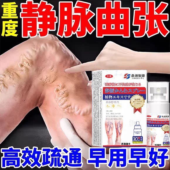 日本静脉曲张腿青筋凸起肿胀抽筋
