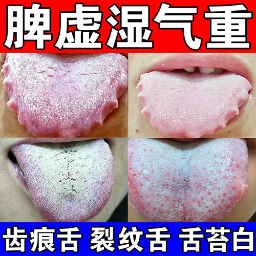 参苓白术散脾胃虚弱湿气重