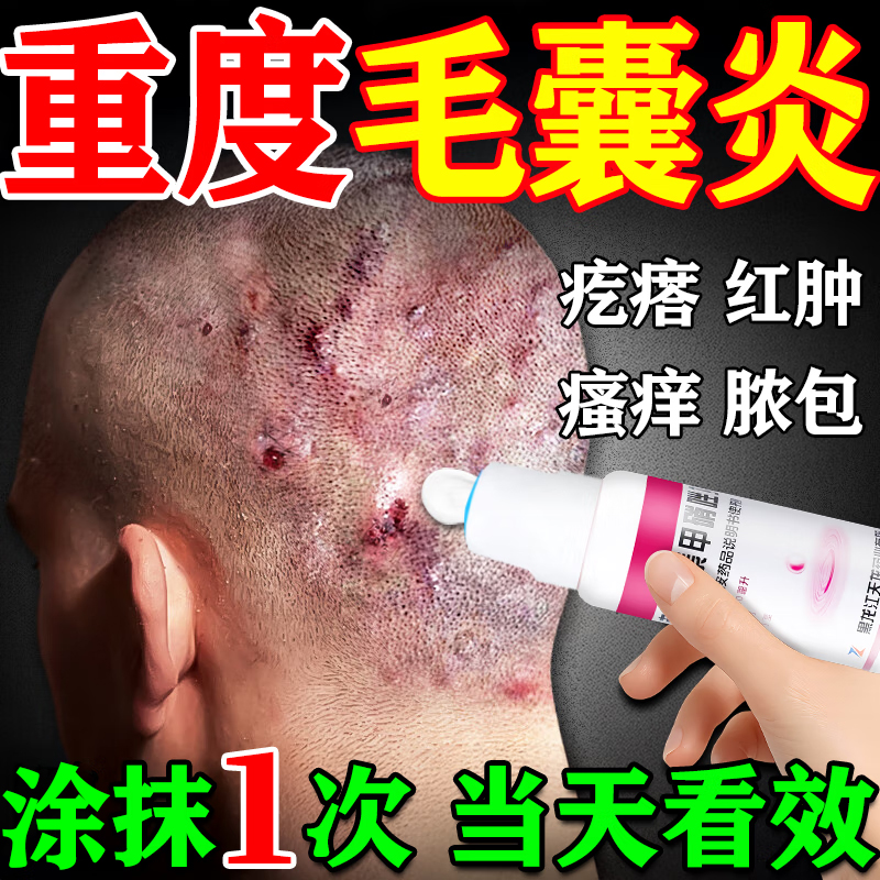 克林霉素甲硝唑搽剂治疗毛囊炎专用药膏头皮屑脂溢性皮炎真菌感染