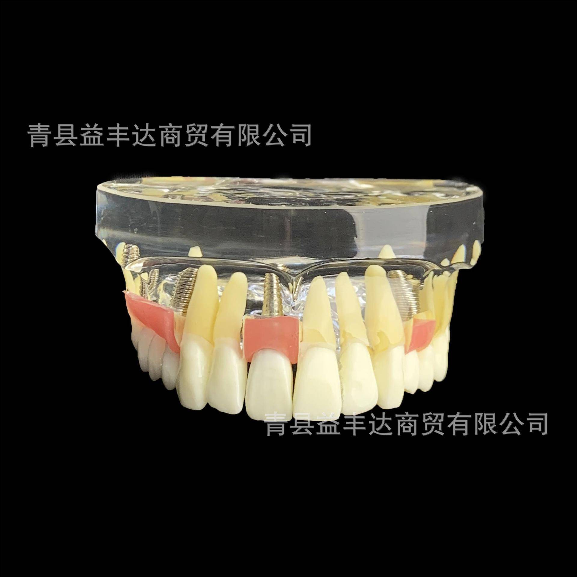 M2005牙齿模型种植牙模型牙齿种植演示模型医患沟通模型