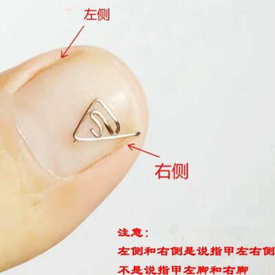 宗健嵌甲单侧矫正丝器 矫形片 拇指小趾2345指甲扎肉卷曲变形甲沟