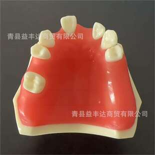 种植练习模型 种植牙缺失模型 牙齿种植模型