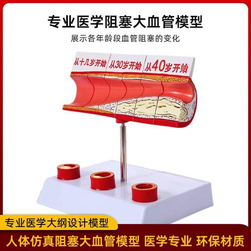 冠状型脉型性心血动管动脉模硬化模人体病558理模型血栓模型